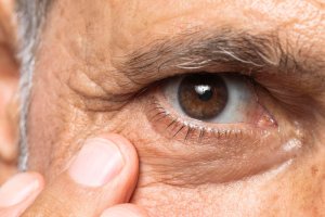 glaucoma